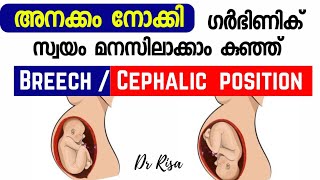 Cephalic vs Breech Baby Movement  Baby Head Down Symptoms Pregnancy Baby Movement [upl. by Mendy]