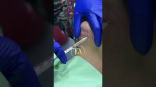 Lipolytic Injections timelessaesthetics drshikhabaghi [upl. by Nileve]