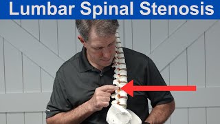 What is Lumbar Spinal Stenosis [upl. by Lona78]