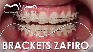 TODO SOBRE LOS BRACKETS ZAFIRO  ¿YA TE DECIDISTE [upl. by Astraea107]