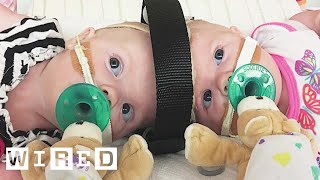 Surgeons Break Down Separating Conjoined Twins  WIRED [upl. by Gnay]