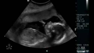 Ultrasound 20 weeks pregnant [upl. by Sirah]