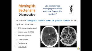 Infectologia  1 Infecciones del sistema nervioso Central [upl. by Evangelina]