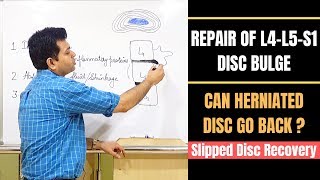 Repair Of Disc Bulge Can Herniated Disc Heal Lumbar Disc Herniation Recovery Slipped Disc Heal [upl. by Snowman]