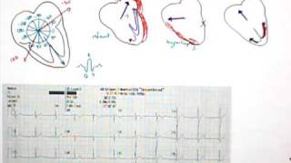 12 Lead EKG Part 5 QRS Axis [upl. by Isaak]