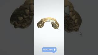 Anterior Teeth Design anteriorteeth smiledesigndental [upl. by Jasun748]