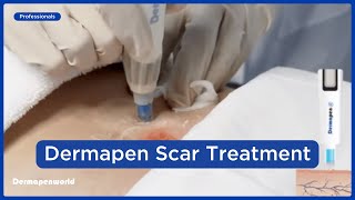 Dermapen 4™ Microneedling  Advanced Scar Treatment Techniques [upl. by Brentt275]