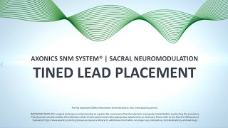 Tined Lead Procedure  Axonics SNM System® [upl. by Cassy]