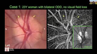 Human Measurements amp Biomarkers of Optic Neuropathies Multi spectral ophthalmic imaging in ODD [upl. by Anitnas702]