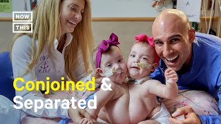 Conjoined Twins Separated After Successful Surgery [upl. by Winslow]