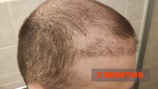 Hair Transplant Results  3 Months FUE Turkey [upl. by Pavlish]