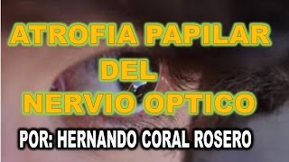 ATROFIA PAPILAR DEL NERVIO ÓPTICO  DEGENERACIÓN DEL NERVIO [upl. by Lerak]