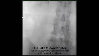 XO Cath Used in a Uterine Artery Embolization without the use of a support catheter [upl. by Hildegaard]