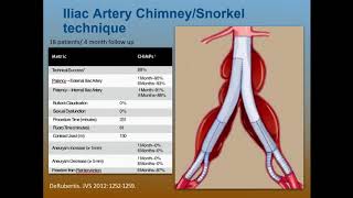 Preserving Hypogastric Flow Branched Iliac Stent Grafts  Steve Henao MD [upl. by Acirred939]