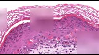 Erythema Multiforme Dermatopathology Easy learning [upl. by Yuu]