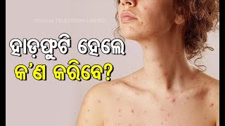 Chickenpox Symptoms Causes amp Treatment [upl. by Alian]