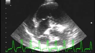 multifocal Ventricular Tachycardia with Right Atrial mass [upl. by Nanerb]