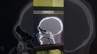 Nasal and zygomatic bone fracture  sagittal view of Ct brain bone window [upl. by Bathsheba]