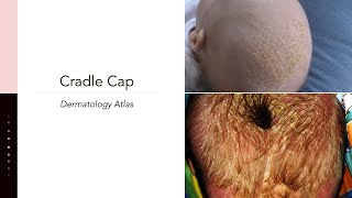 Cradle Cap Infantile Seborrheic Dermatitis [upl. by Aljan124]