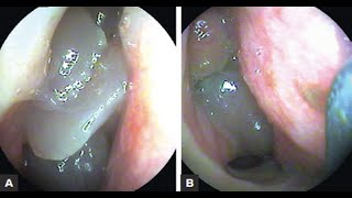 Nasal Polyposis [upl. by Elmo]