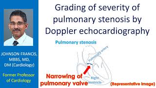 Grading of severity of pulmonary stenosis by Doppler echocardiography [upl. by Zelde617]