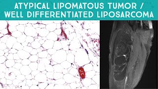 Well differentiated liposarcoma  quotAtypical lipomatous tumorquot mimicking lipoma Oregon Case 13 [upl. by Carney]