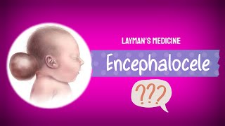 EncephaloceleNeural Tube defectCongenital disorders animated videoEnglish video [upl. by Gnuhc]