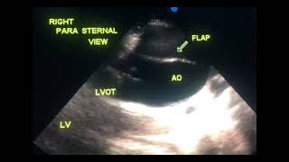 Asymptomatic dissection of aorta to drahmadmirdamadisiJSbA7GCDIDSLEpD [upl. by Noillimaxam502]