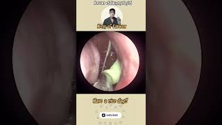 귀지형 콧물 부비동염 축농증 비염 코청소 이비인후과 rhinorrhea rhinitis sinusitis ASMR [upl. by Miarzim568]