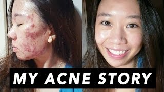 My Full Acne Story  Skincare Routine [upl. by Odlamur]