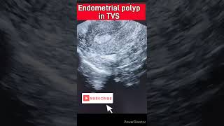 जानिए endometrial ployp sonography में कैसा दिखता है endometrial polyp polypheavy mensestvs [upl. by Eiramik]