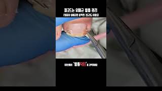 🔨내성 발톱🔨가족이 다 감염될 수 있습니다 😭 발톱닥터 내성발톱 내성발톱교정 내성발톱관리 지축역 [upl. by Horvitz]