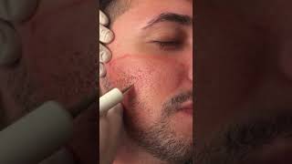 Tratamento de cicatrizes de acne com jato de plasma [upl. by Moule]