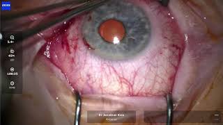 Pterygium Removal Surgery [upl. by Enalahs]