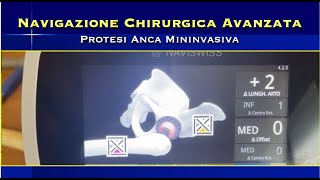 Navigazione Avanzata Protesi Anca Mininvasiva [upl. by Hwang129]