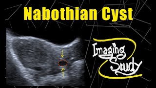 Nabothian Cyst  Ultrasound  Case 70 [upl. by Binette855]