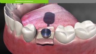 Biotech Dental Protocole chirurgical de pose dun implant dentaire KONTACT souscrestal [upl. by Farhsa]