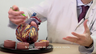 Cardiopatía Isquémica  PortalCLÍNIC [upl. by Therese]