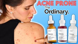 3 Best Acne Products From The Ordinary  For Blemish amp Breakout Prone Skin [upl. by Nickerson]