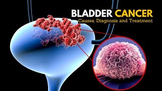 Bladder Cancer Causes Signs and Symptoms Diagnosis and Treatment [upl. by Thad640]