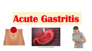 Acute Gastritis Stomach Inflammation  Causes Signs amp Symptoms Diagnosis Treatment [upl. by Ydnew]