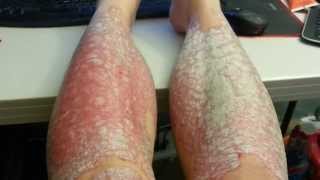 Psoriasis Scrape  Side by side comparison [upl. by Stephens]