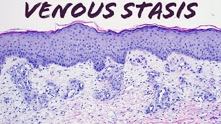 Venous stasis vascular change pathology dermatology dermatopathology [upl. by Siuraj]