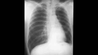 Parenchymal causes  emphysema  swyer james mcleod syndrome [upl. by Nashoma]