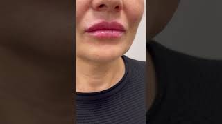 Russian Lip Filler JUVEDERM 1ml Rus Tekniği dudak dolgusu  Dermatolog Dr Mustafa TÜMTÜRK [upl. by Marolda]