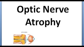 Ophthalmology 334 Optic Atrophy Primary Secondary Consecutive Marcus Gunn Pupil RAPD drusen [upl. by Bhayani839]