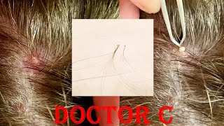 INGROWN HAIR ON HEAD 06 [upl. by Spohr]