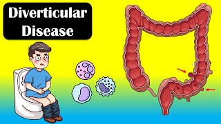 Diverticular Disease And Diverticulitis  Causes Signs amp Symptoms Diagnosis Treatment [upl. by Effy]