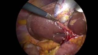 Laproscopical cholecystectomy DrTalib H ALShawoush Specialist Surgeon [upl. by Ardua871]