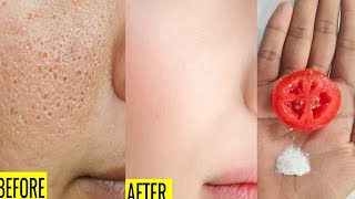 How to close pores permanently  Open pores Treatment at Home  How to shrink pores naturally [upl. by Suirada]